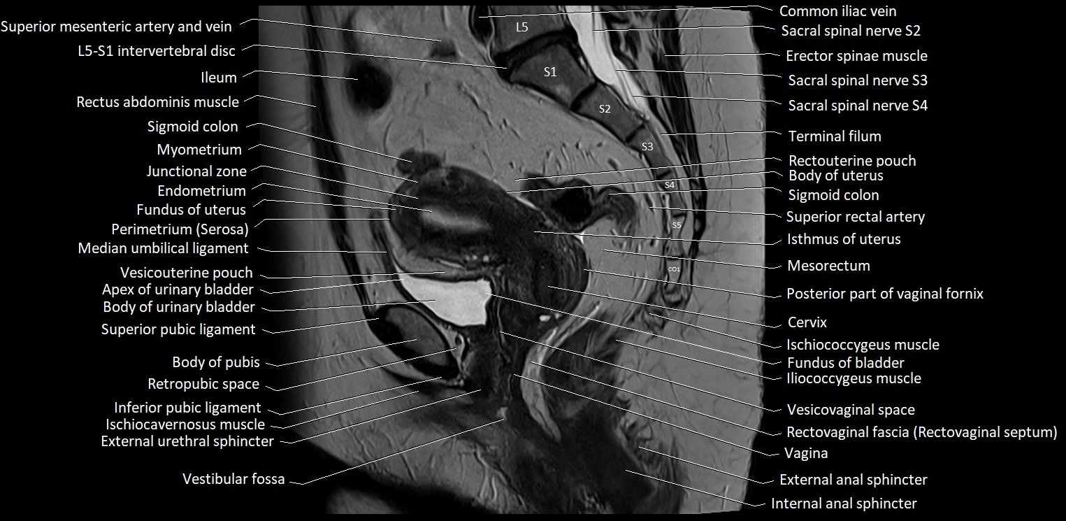 Sagittal cross sectional anatomy of female pelvis (MRI 3T) image 20.webp